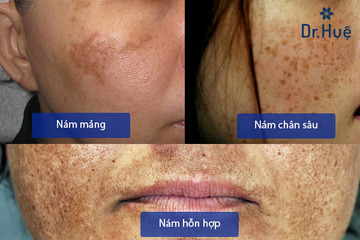 Nám Da Là Gì? Nguyên Nhân Gây Ra Nám Da