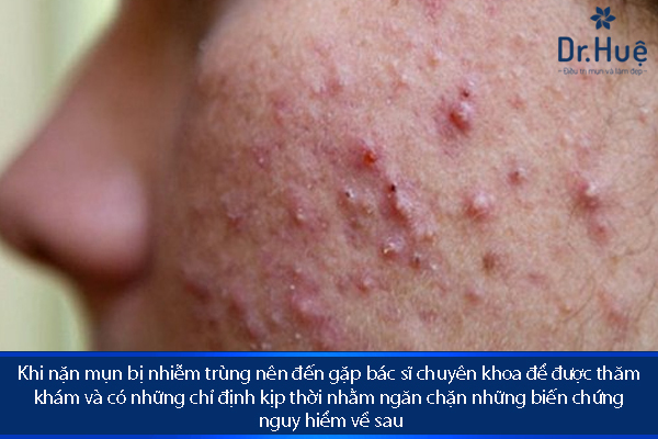 Nặn mụn xong bị viêm nhiễm trùng sưng tấy phải làm gì