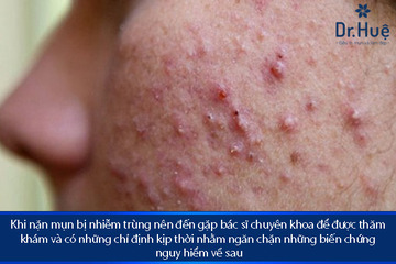 Nặn mụn xong bị viêm nhiễm trùng sưng tấy phải làm gì