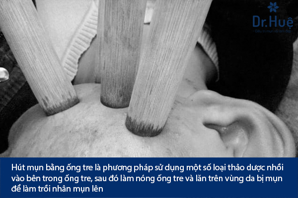 Nặn Mụn Lăn Bằng Ống Tre Có Tốt Không?