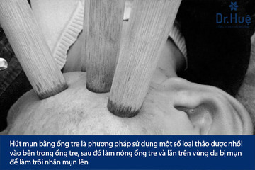 Nặn Mụn Lăn Bằng Ống Tre Có Tốt Không?