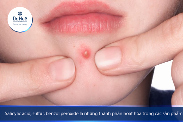 Nặn mụn như thế nào để không bị thâm