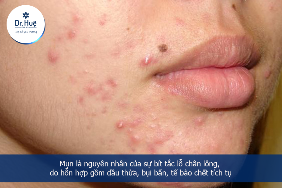 Nguyên nhân gây mụn 