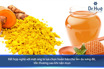 Bôi mật ong lên mụn mới nặn có được không