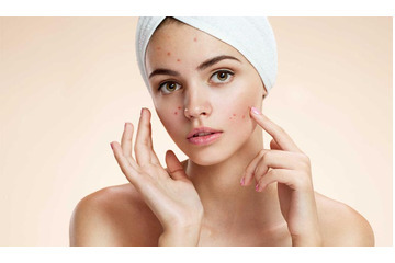 Nắng mưa là chuyện của trời, bị mụn là chuyện cần điều trị ngay!