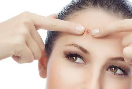 Nên điều trị mụn sớm - lời khuyên hữu ích về điều trị mụn