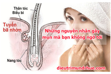 Bất ngờ với những nguyên nhân gây ra mụn mà ít ai biết