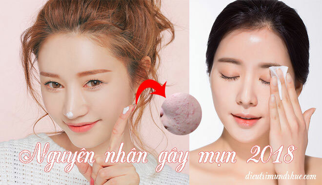 Nguyên nhân gây mụn 2018 bạn đã biết chưa?