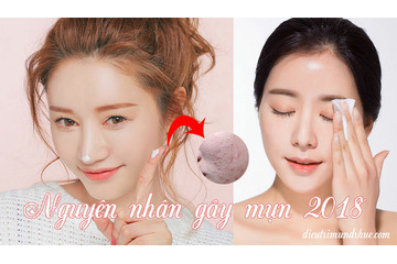 Nguyên nhân gây mụn 2018 bạn đã biết chưa?