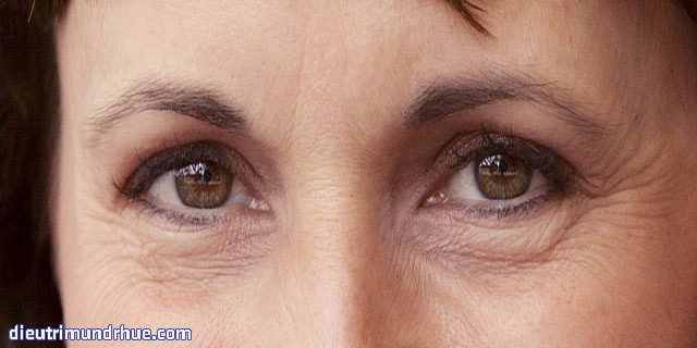 Nguyên nhân hình thành vết chân chim và cách khắc phục - Điều trị mụn Dr Huệ - Hình 2