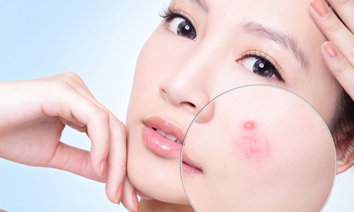 Nguyên nhân nào gây ra mụn trứng cá?