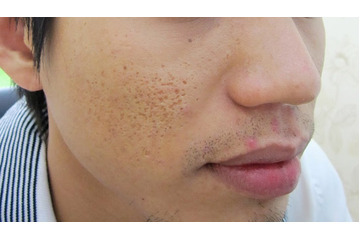 Điều trị sẹo lõm ở đâu là tốt nhất?