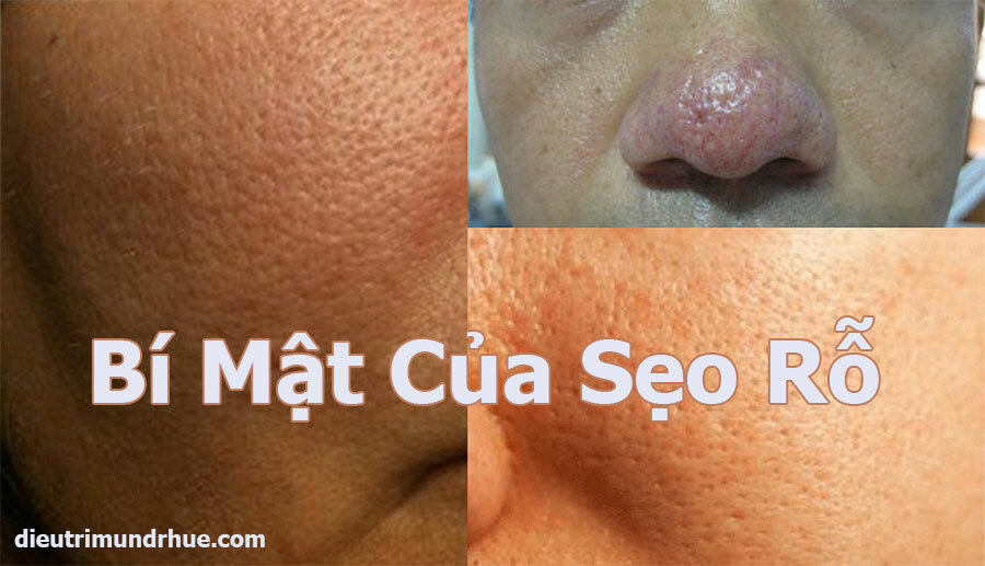 Những bí mật về sẹo rỗ mà không phải ai cũng biết