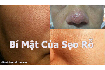 Những bí mật về sẹo rỗ mà không phải ai cũng biết