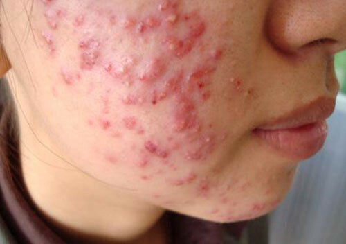 Những biến chứng thường gặp sau khi điều trị mụn không đúng cách?