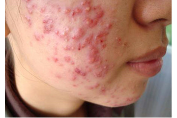 Những biến chứng thường gặp sau khi điều trị mụn không đúng cách?