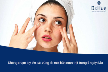 Những Cách Chăm Sóc Da Mặt Sau Khi Đốt Mụn Thịt