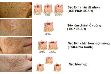 Những đặc điểm nổi bật của phương pháp lăn kim điều trị sẹo rỗ