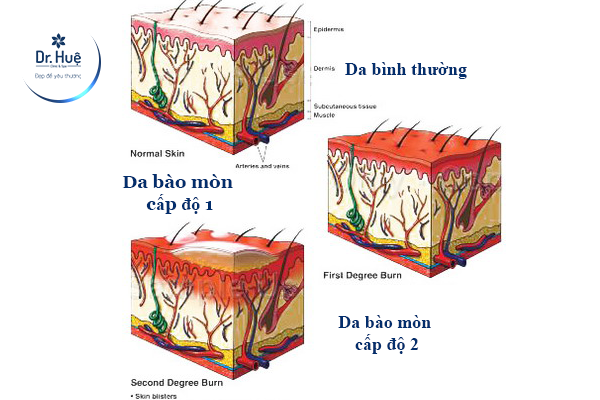 Da bị bào mòn 