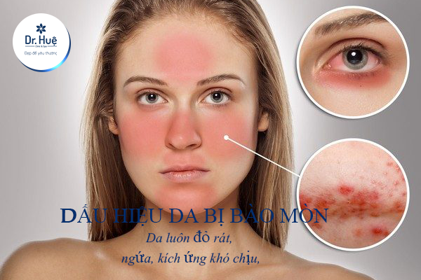 Dấu hiệu da bị bào mòn