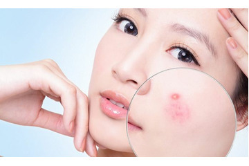 Những điều cần chú ý khi điều trị mụn bọc có mủ