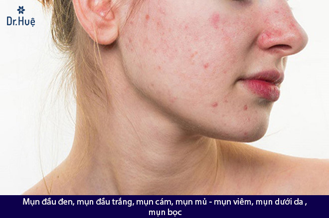 Những loại kem thuốc chấm mụn nào tốt nhất hiện nay