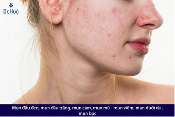 Những loại kem thuốc chấm mụn nào tốt nhất hiện nay