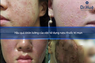 Sử dụng rượu thuốc trị mụn có tốt không có an toàn không
