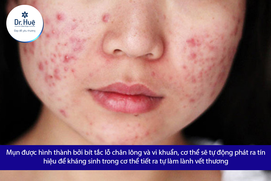 Những tác hại của việc tự ý nặn mụn ở nhà là gì