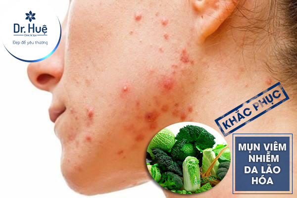 Khắc phục mụn viêm, da lão hóa 