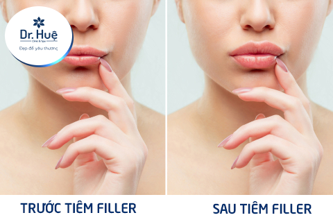 Tiêm filler làm đầy 