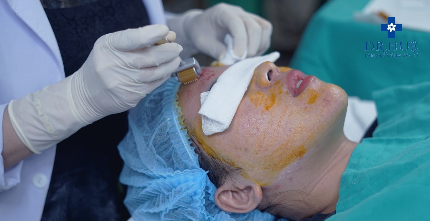 phương pháp lăn kim con đường ngắn nhất để xóa sạch sẹo rỗ