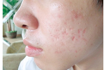 Quy trình điều trị sẹo lõm tốt nhất tại Dr. Huệ