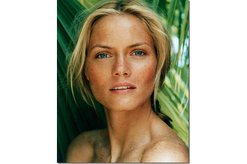 Rối loạn sắc tố da là gì - Rối loạn sắc tố da có chữa được không