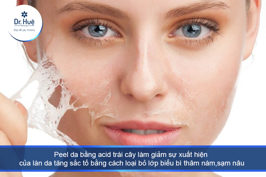peel da bằng acid trái cây là phương pháp phổ biến điều trị chứng tăng sắc tố da 