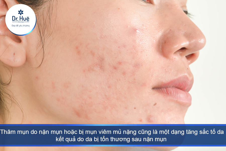 thâm mụn do nặn mụn là nguyên nhân chủ yếu làm tăng sắc tố da 