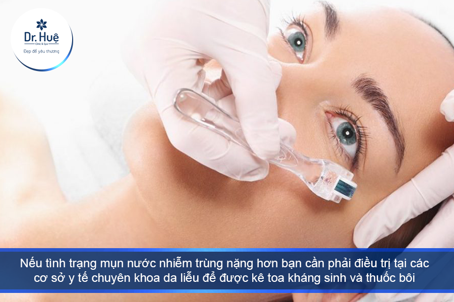 Nếu tình trạng  nhiễm trùng nặng hơn phải điều trị tại các cơ sở y tế chuyên khoa da liễu