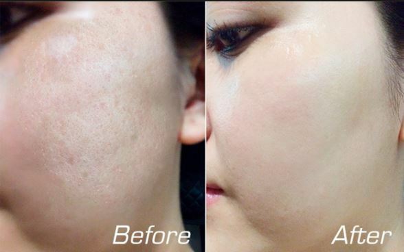 Sẹo rỗ điều trị bằng phương pháp tự nhiên có được không?