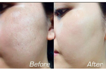 Sẹo rỗ điều trị bằng phương pháp tự nhiên có được không?