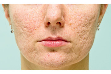 Sẹo rỗ là gì? Làm sao để trị sẹo rỗ lâu năm trên da?