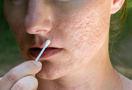 Sẹo rỗ là gì? Phải điều trị sẹo rỗ như thế nào?