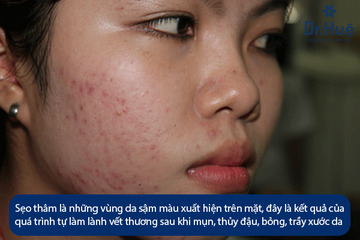 Sẹo Thâm Là Gì - Cách Trị Sẹo Thâm Lâu Năm Ở Mặt