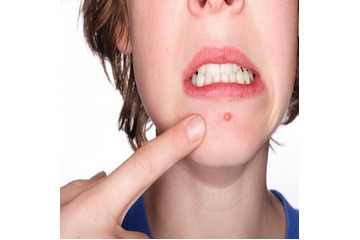 Tại sao bạn lại bị mụn?