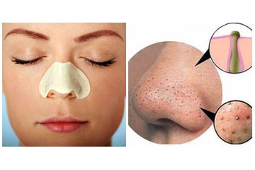 Cách điều trị sẹo rỗ khác gì với điều trị mụn?