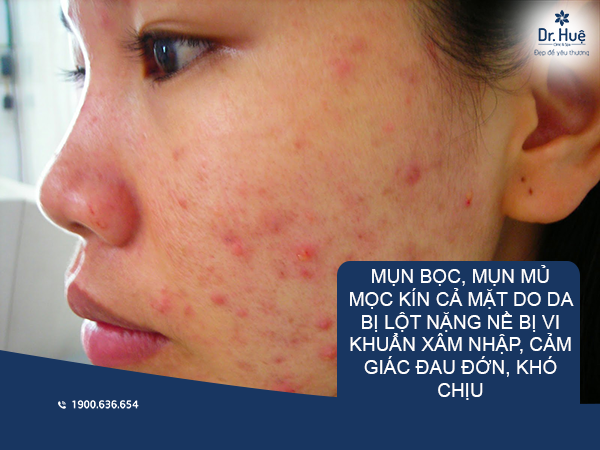 Mụn do thuốc bắc 