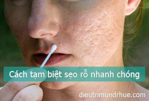 Tạm biệt sẹo rỗ thật nhanh chóng với phương pháp sau đây!!!!
