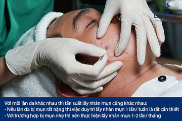 Tần Suất Lấy Nhân Mụn Bao Nhiêu Lần Một Tháng?