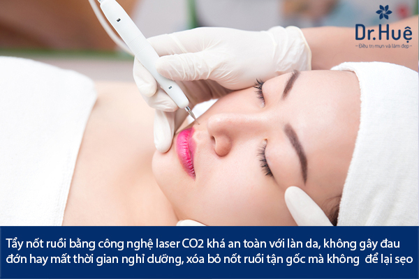 Tẩy Nốt Ruồi Bằng Laser Có Để Lại Sẹo Không Có Nguy Hiểm Không