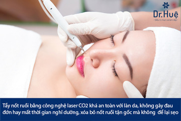 Tẩy Nốt Ruồi Bằng Laser Có Để Lại Sẹo Không Có Nguy Hiểm Không