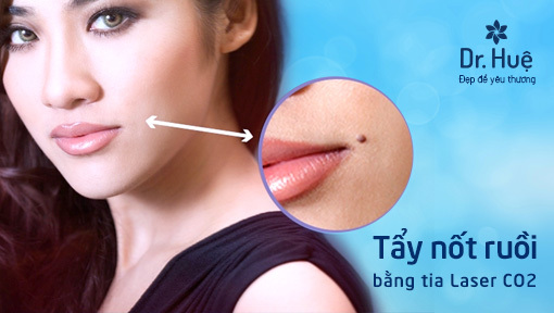 Xóa nốt ruồi bao nhiêu tiền bằng tia Laser tại Dr. Huệ